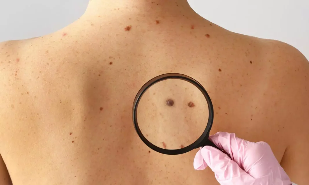 Moles Cancer: Don’t think of birth .. Mole Cancer
– PARAHUSHAR NEWS