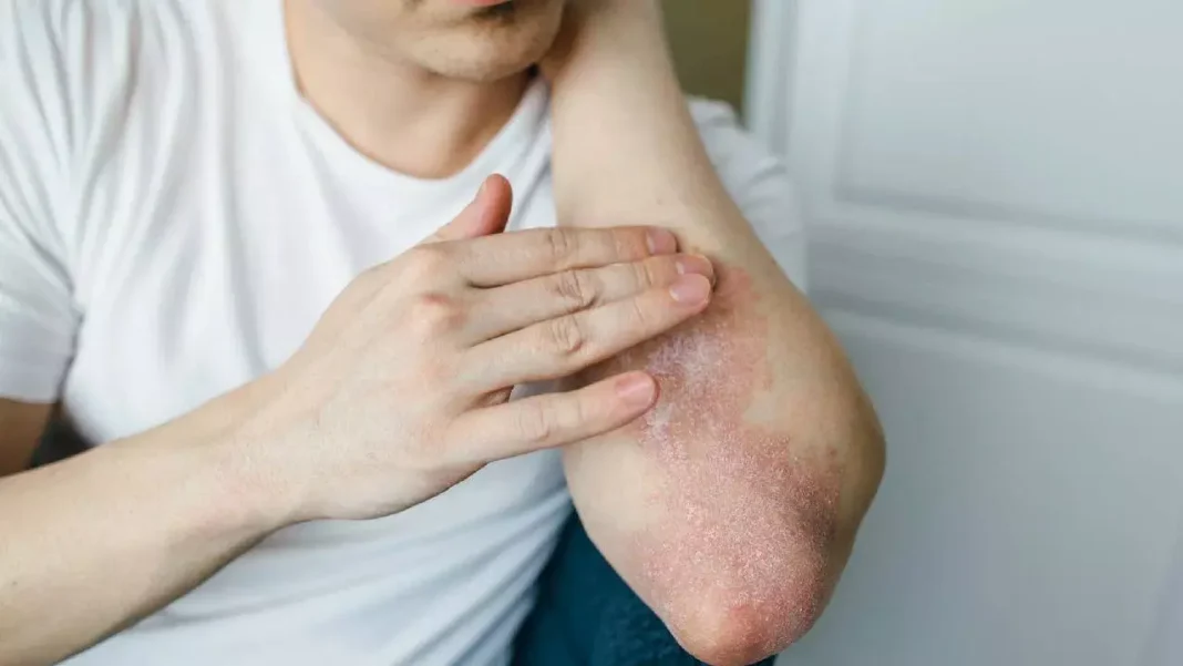 Monsoon Health Alert: Beware of fungal infections during the rainy season .. Do not ignore these symptoms!
– PARAHUSHAR NEWS