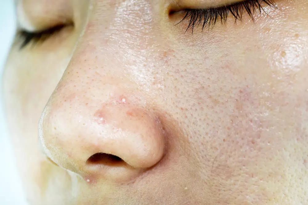 Whiteheads: To get rid of whiteheads, just do this!
– PARAHUSHAR NEWS