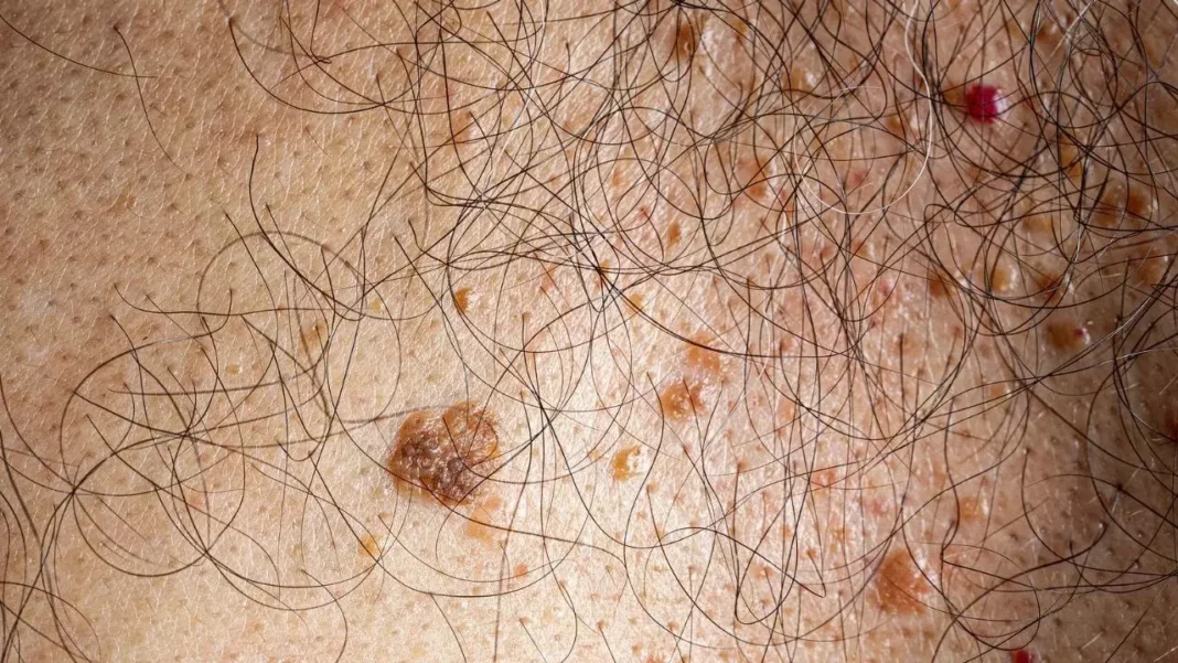 Skin Cancer: Can moles cause cancer? What are experts?
– PARAHUSHAR NEWS