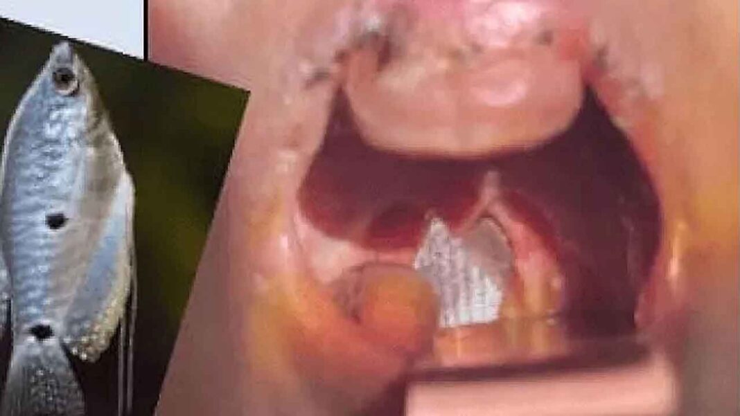 లైవ్ ఫిష్ పసిపిల్లల గొంతులో చిక్కుకుంది; శస్త్రచికిత్స తర్వాత తొలగించబడింది
– PARAHUSHAR NEWS